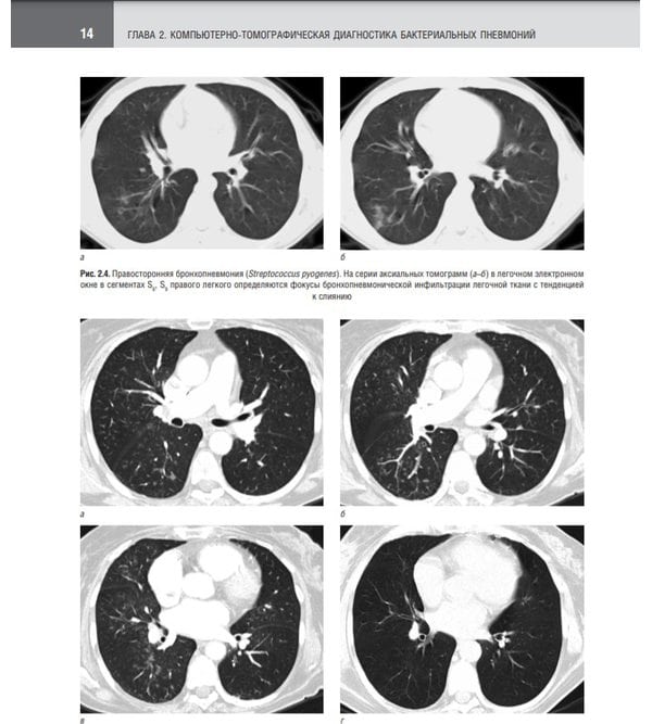 Компьютерная томография в диагностике пневмоний. Атлас