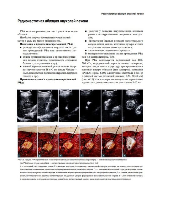Атлас операций при злокачественных опухолях печени и поджелудочной железы (билиопанкретодуоденальной зоны)