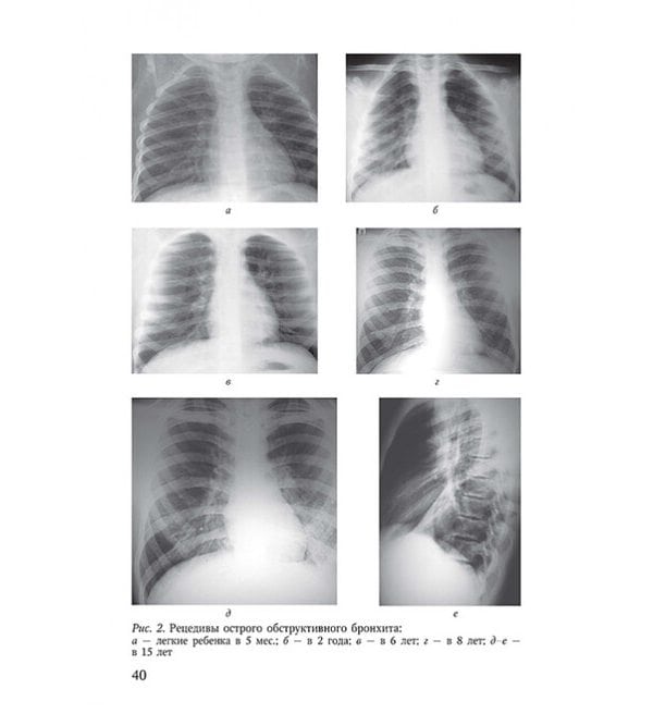 Особенности болезней органов дыхания у детей с дисплазией соединительной ткани