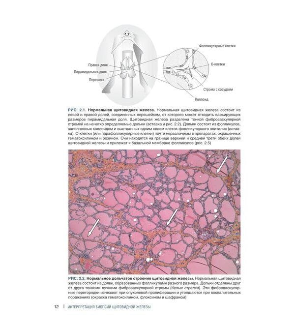Интерпретация биопсий щитовидной железы