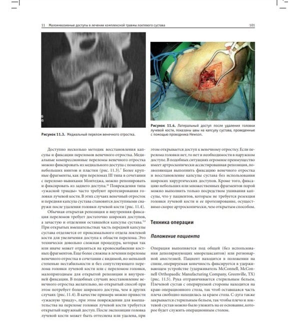 Минимально инвазивные вмешательства в ортопедии: в 2-х томах. Том 1