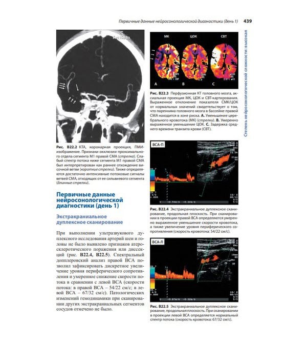 Нейросонология и нейровизуализация при инсульте