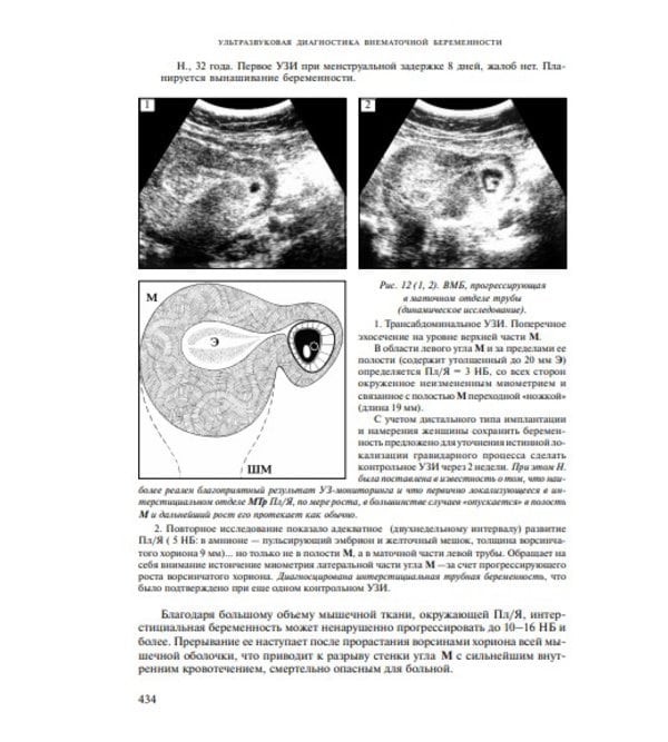 Ультразвуковая диагностика внематочной беременности