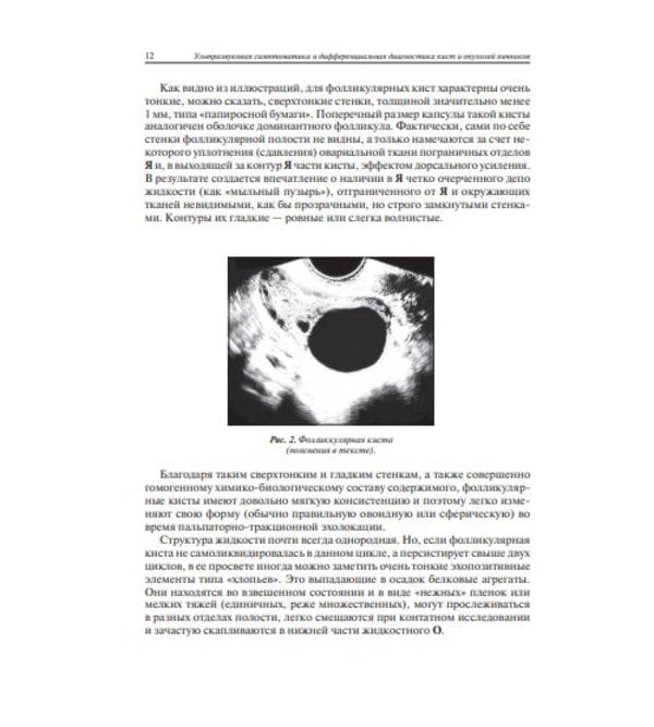 Ультразвуковая симптоматика и дифференциальная диагностика кист и опухолей яичников