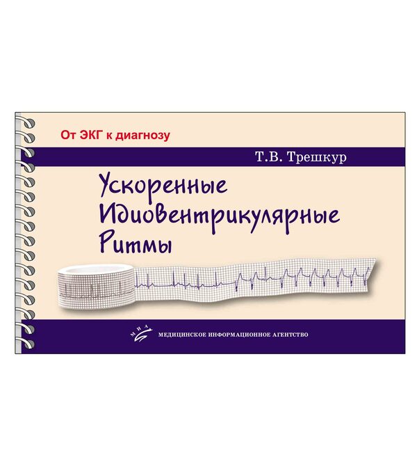 Ускоренные идиовентрикулярные ритмы