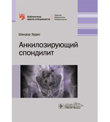 Анкилозирующий спондилит