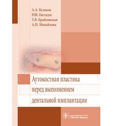 Аутокостная пластика перед выполнением дентальной имплантации
