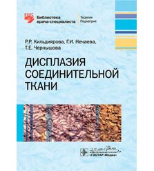 Дисплазия соединительной ткани