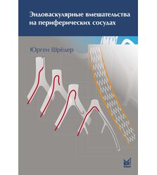 Эндоваскулярные вмешательства на периферических сосудах