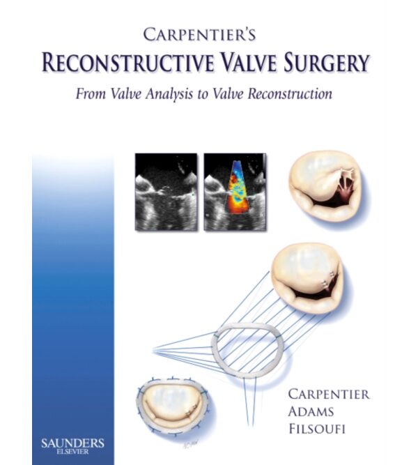 Реконструктивна хірургія клапанів серця за Карпант'є (Carpentier's Reconstructive Valve Surgery)