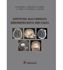 Хирургия массивного ишемического инсульта