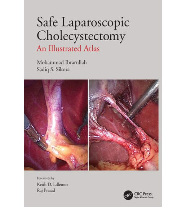 Safe Laparoscopic Cholecystectomy An Illustrated Atlas