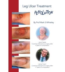 Leg Ulcer Treatment Revolution