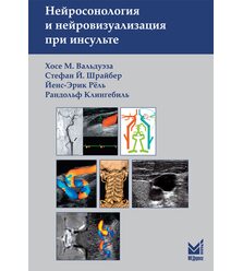 Нейросонология и нейровизуализация при инсульте